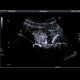 Focal nodular hyperplasia (FNH), CEUS: US - Ultrasound